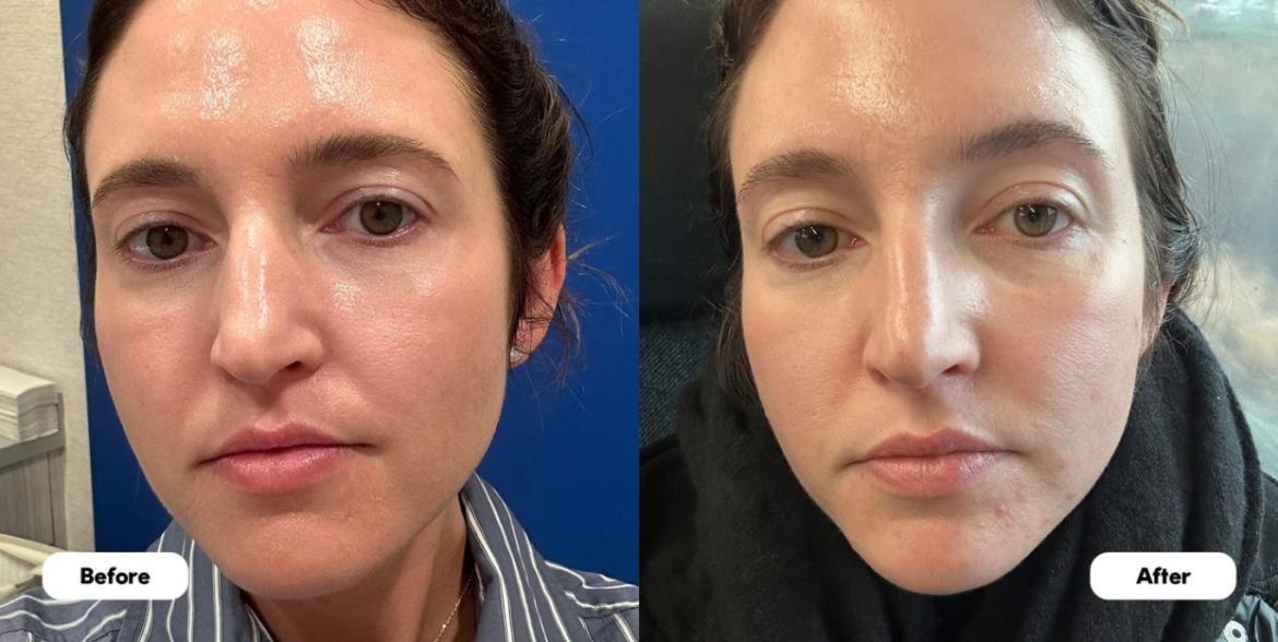Discover the Trending Non-Surgical Face-Lift Treatment Everyone Loves